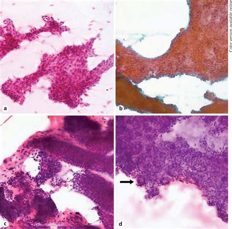 Figure From Fine Needle Aspiration Cytology Of Benign Salivary Gland