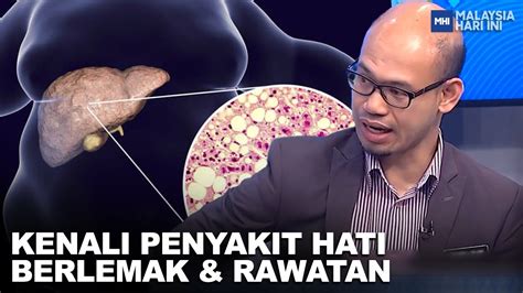 Kenali Penyakit Hati Berlemak Rawatan MHI 21 Jun 2023 YouTube