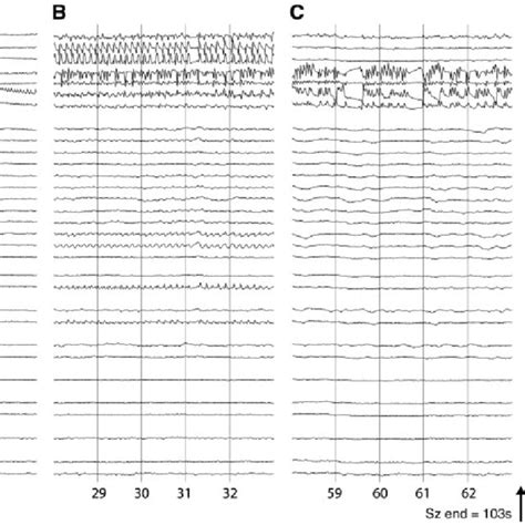 Example Intracranial Eeg Recording During A Temporal Lobe Download Scientific Diagram