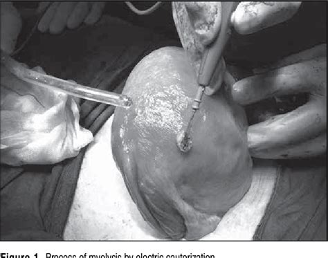 Figure 1 From Myomectomy During Cesarean Section And Adhesion Formation