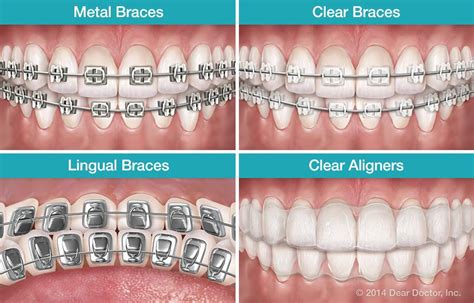 Types of Braces: To meet the needs of patients, there are different ...