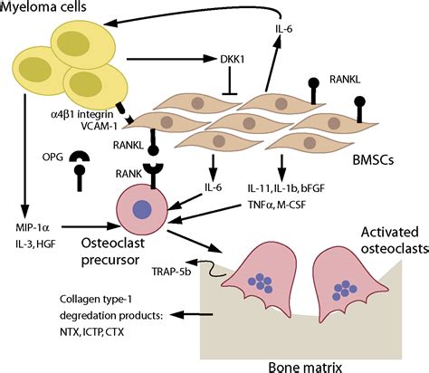 Pathophysiology Of Multiple Myeloma Bone Disease Hematology Oncology