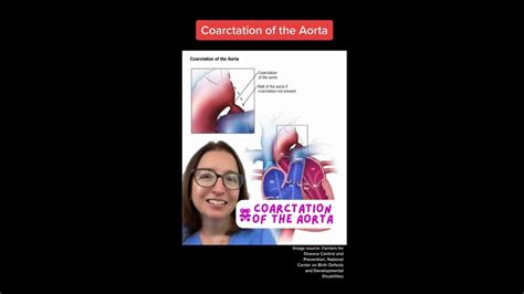 Coarctation Of The Aorta Pediatrics Leveluprn Youtube