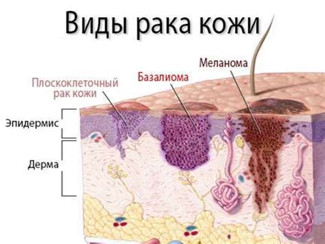 Рак кожи - презентация онлайн