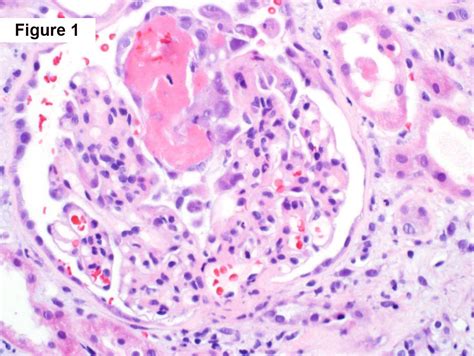 Crescentic Iga Nephropathy Teaching Point Arkana Laboratories