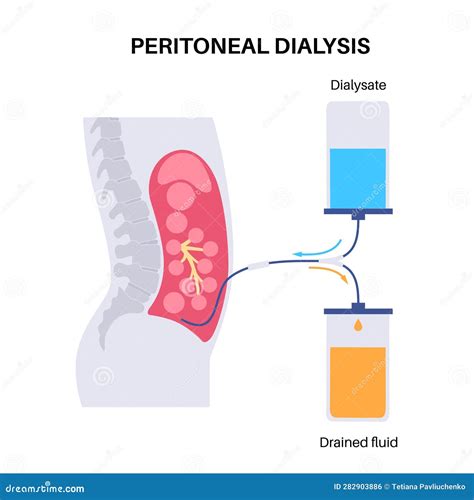 Abdominal Paracentesis Poster Vector Illustration