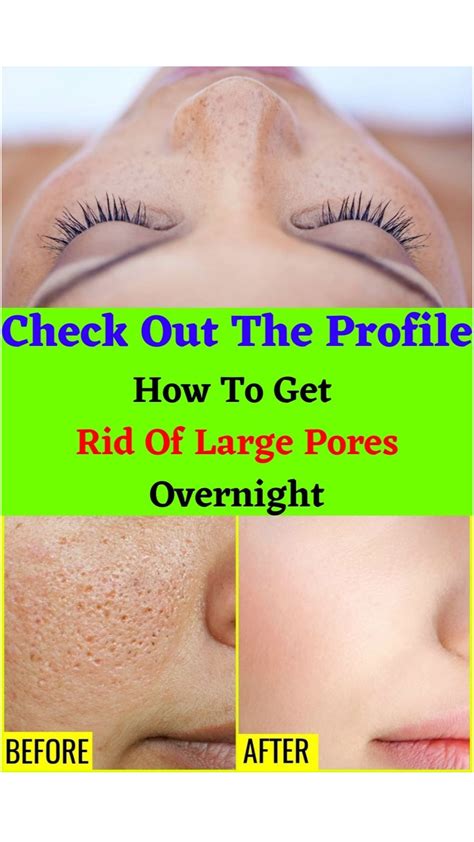 How To Get Rid Of Large Pores With Homemade Remedies Artofit