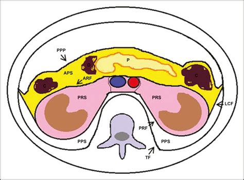 Practical Approach To Primary Retroperitoneal Masses In Adults Nerve Structure Epidermoid Cyst