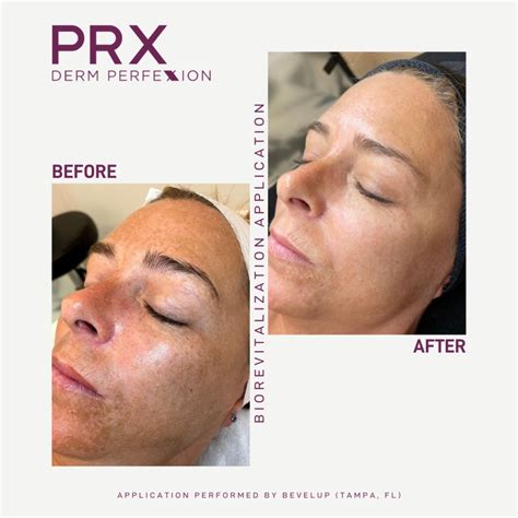 Prx Derm Perfexion Treatment Gallery The Beauty Spot In Boulder Colorado