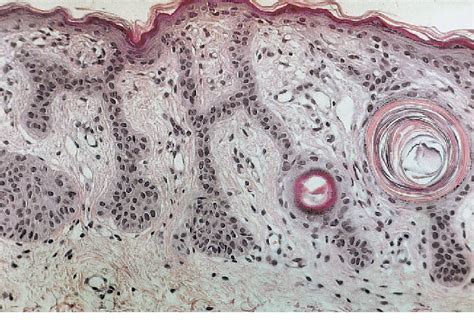 Figure 2 from Successful Treatment of Dowling–Degos Disease with Er:YAG ...