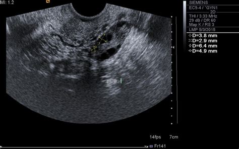 Pcos Ovary Ultrasound