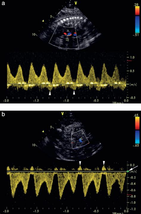 Isuog Practice Guidelines Use Of Doppler Ultrasonography In Obstetrics