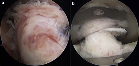 The Cyclops Lesion After Bicruciate Retaining Total Knee Replacement