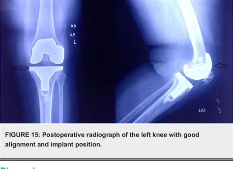 Figure 15 From Total Knee Arthroplasty In Ochronosis A Rare Condition