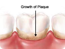 Plaque Formation with its Subsequent Damages to Our Dental Health and ...