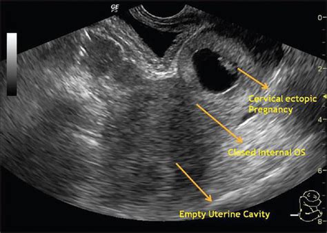 Caesarean Scar Ectopic Pregnancy Intechopen