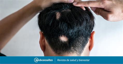 Olumiant Primer F Rmaco Espec Fico Aprobado Para La Alopecia Areata