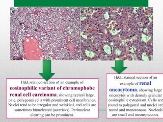 Carcinoma Renal Cromofobo Variante Eosinofila Vs Oncocitoma Renal