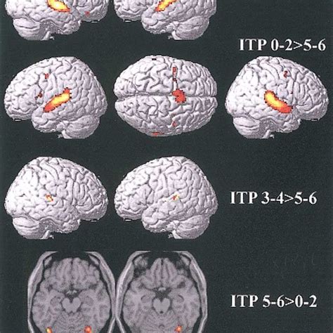 Brain Activation Pattern P 0 05 Corrected Comparing Initial ITP With