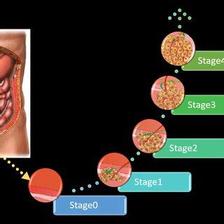 The different stages of colon cancer. | Download Scientific Diagram