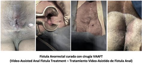 Vaaft Cirug A De F Stula Anal Sin Incontinencia Coloclinic