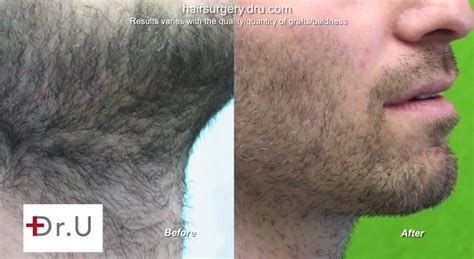 Beard Hair Extraction Wound Healing After 4500 Ugraft Extractions