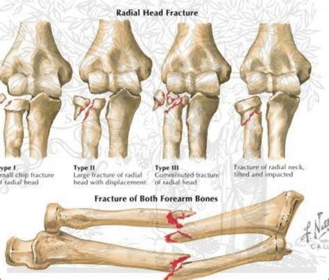 Radial Head Fracture - Recovery, Treatment, Diagnosis