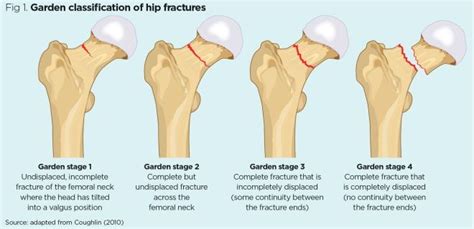 Fig Garden Classification System Of Femoral Neck Fractures A