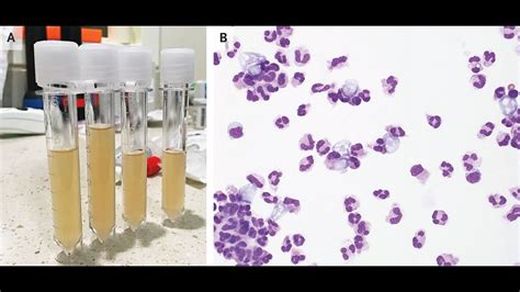 Meningitis Bei Naegleria Fowleri Youtube