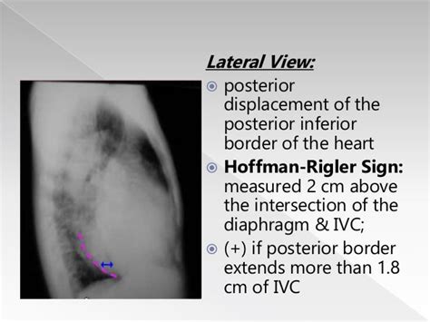 Acquired Valvular Diseases Radiology