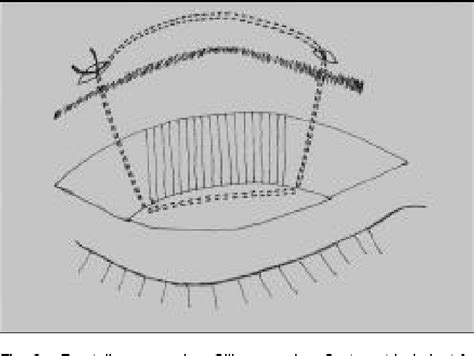 Pdf Apraxia Of Eyelid Opening Clinical Features And Therapy Semantic Scholar