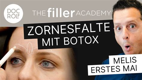 Botox Spritzen Lernen Die Zornesfalte Tfa By Docrolf Youtube