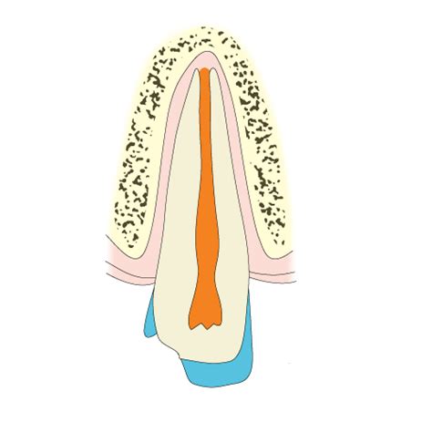 Enamel Dentin Fracture