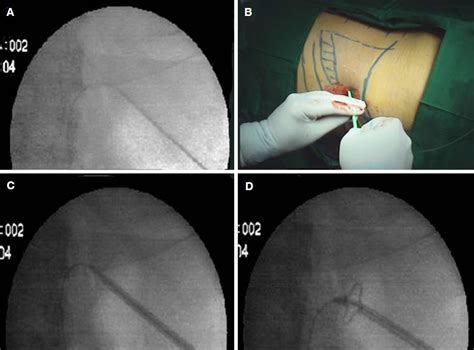 Percutaneous Nephrostomy Step By Step