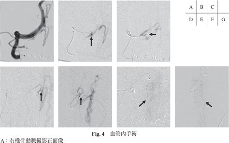 Figure 4 From A Case Of Dural Arteriovenous Fistula At The