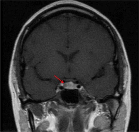 Pituitary Magnetic Resonance Imaging MRI Coronal Imag Open I