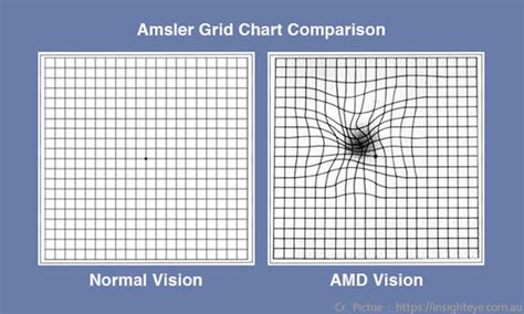 Eye Test Chart For Macular Degeneration: A Visual Reference of Charts ...