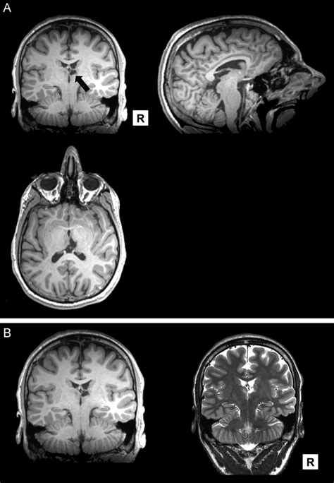 A T1 Weighted MRI Scans Of N C With Arrow Pointing To His Right