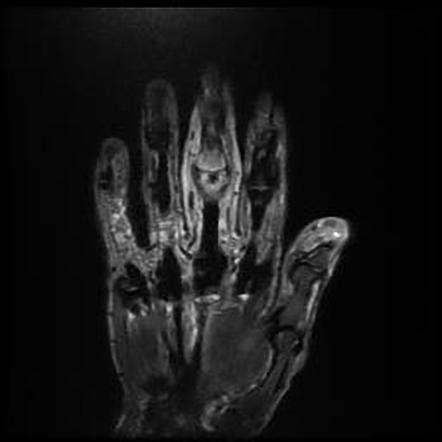 Septic Arthritis Hand