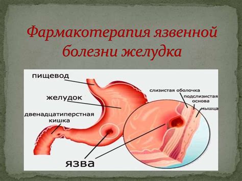 Фармакотерапия язвенной болезни желудка - online presentation