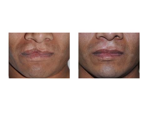 Adult Cleft Lip Repair Archives