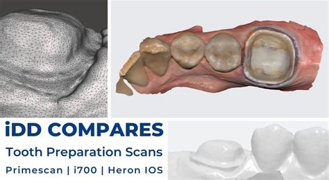 CEREC Primescan Vs Medit I700 Vs Heron IOS Expensive Vs Cheap