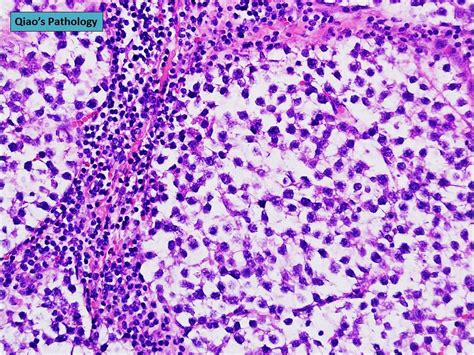 Qiaos Pathology Testicular Seminoma Or Classic Seminoma A Photo