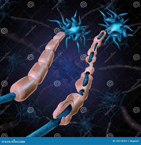 Multiple Sclerosis Anatomical Vector Illustration Diagram Medical