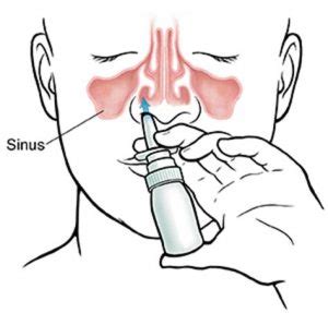 The Correct Way To Use A Nasal Spray Atlantic Ear Nose Throat