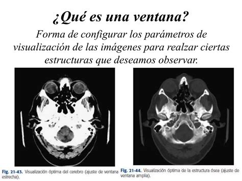 Tomografía Computarizada Y Tomografía De Haz Cónico Ppt