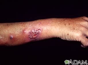 Sporotrichosis Information | Mount Sinai - New York