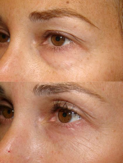 DO NOT Rules Of Lower Lid Blepharoplasty