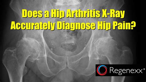 Osteoarthritis Hip Pain Location Chart