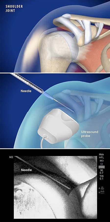 Ultrasound Guided Injection For Shoulder Pain Central Coast Orthopedic Medical Group